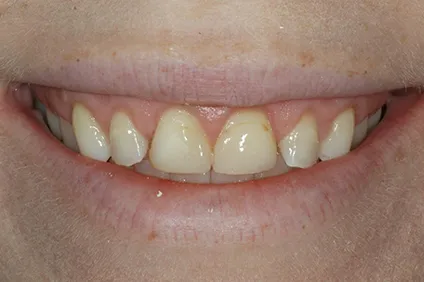 healthier smile by dentist arcadia - before