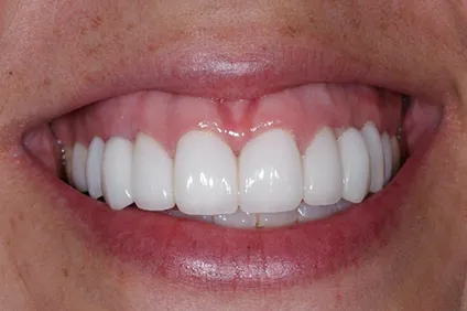 smile transformation by dentist arcadia - After