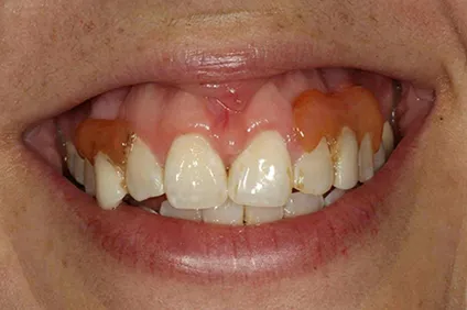 smile transformation by dentist arcadia - before